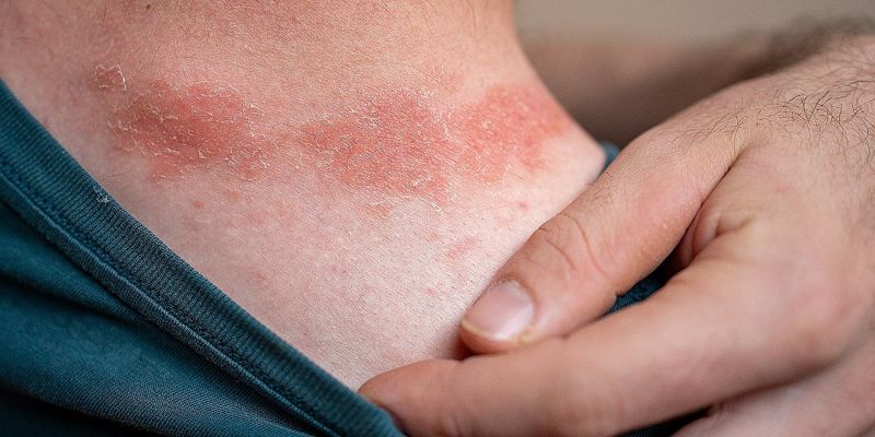 Svjetski dan psorijaze: Hronična upalna bolest koja zahtijeva rano prepoznavanje i cjelovit pristup liječenju