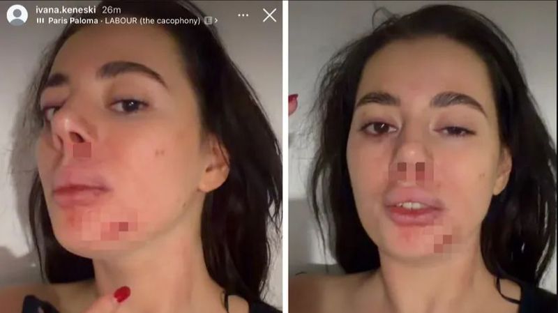 Bivša učesnica rijalitija Ivana Keneški objavila fotografije povreda i upozorila na nasilje