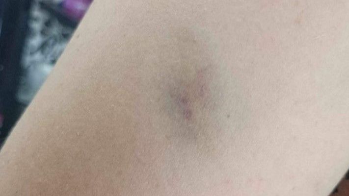 Učestale modrice bez jasnog povoda: Simptomi koje ne treba zanemarivati