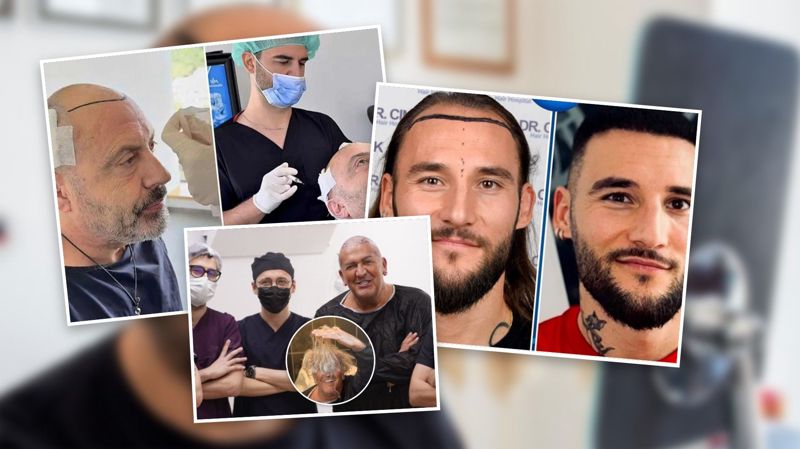 Poznati muškarci otvoreno o transplantaciji kose: Za mladalački izgled izdvajaju se znatne sume